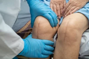 فیزیوتراپی تعویض مفصل زانو در منزل